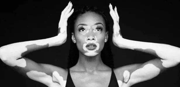 Winnie Harlow