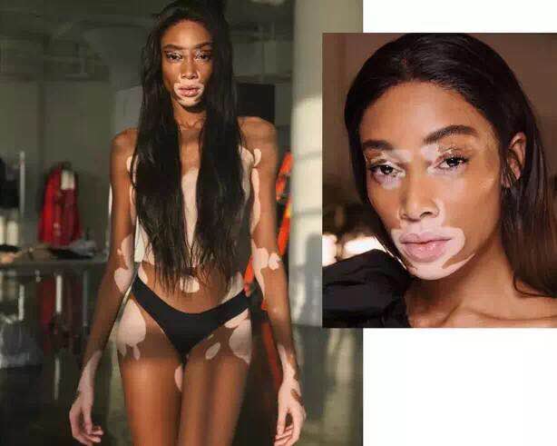 Winnie Harlow