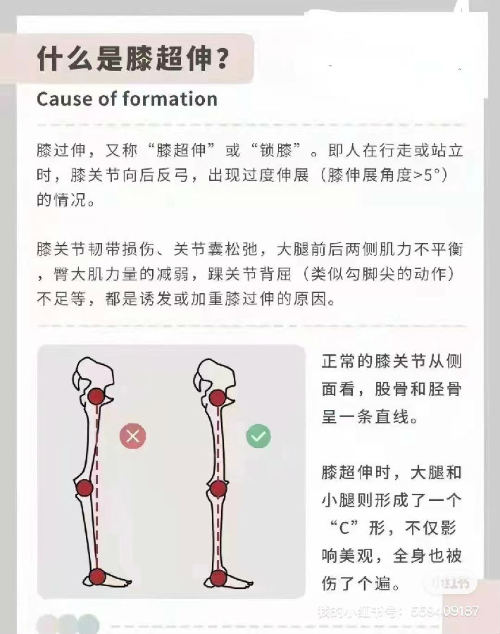 少儿形体问题—膝超伸的危害